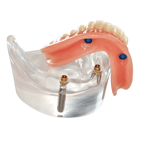 Протез на 2х имплантах. Съемный протез на имплантатах. Съемный протез на 2 имплантатах. Съемный протез на двух имплантах.